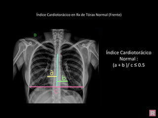 Índice Cardiotorácico en Rx de Tórax Normal (Frente)
Índice Cardiotorácico
Normal :
(a + b )/ c ≤ 0.5
 
