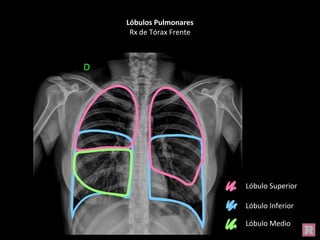 Lóbulos Pulmonares
Rx de Tórax Frente
Lóbulo Superior
Lóbulo Inferior
Lóbulo Medio
 