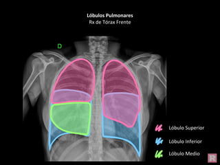 Lóbulos Pulmonares
Rx de Tórax Frente
Lóbulo Superior
Lóbulo Inferior
Lóbulo Medio
 