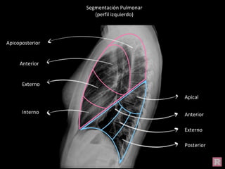 Segmentación Pulmonar
(perfil izquierdo)
Apicoposterior
Anterior
Externo
Interno
Apical
Anterior
Externo
Posterior
 