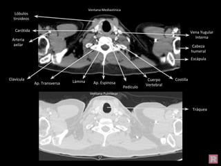 Ventana Mediastínica
Ventana Pulmonar
Tráquea
Vena Yugular
Interna
Carótida
Arteria
axilar Cabeza
humeral
Escápula
Costilla
Clavícula
Ap. Transversa Lámina Ap. Espinosa
Pedículo
Cuerpo
Vertebral
Lóbulos
tiroideos
 