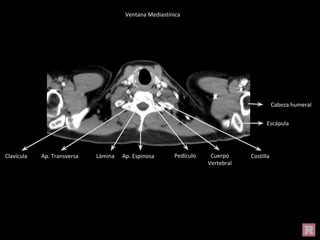 Cabeza humeral
Escápula
Costilla
Clavícula Ap. Transversa Lámina Ap. Espinosa Cuerpo
Vertebral
Pedículo
Ventana Mediastínica
 