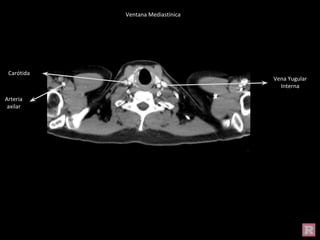 Vena Yugular
Interna
Carótida
Arteria
axilar
Ventana Mediastínica
 