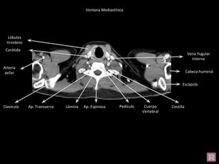 Cabeza humeral
Escápula
Costilla
Clavícula Ap. Transversa Lámina Ap. Espinosa Cuerpo
Vertebral
Pedículo
Ventana Mediastínica
Vena Yugular
Interna
Carótida
Arteria
axilar
Lóbulos
tiroideos
 