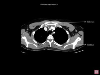 Ventana Mediastínica
Esternón
Escápula
Ventana Mediastínica
 