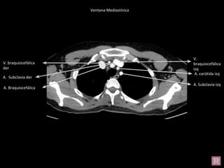 Ventana Mediastínica
V.
braquiocefálica
izq
V. braquiocefálica
der
A. carótida izq
A. Subclavia izq
A. Braquiocefálica
A. Subclavia der
Ventana Mediastínica
 