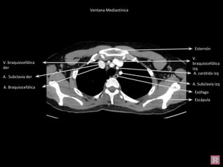 Ventana Mediastínica
Ventana Mediastínica
Esternón
Escápula
V.
braquiocefálica
izq
V. braquiocefálica
der
A. carótida izq
A. Subclavia izq
A. Braquiocefálica
A. Subclavia der
Esófago
 
