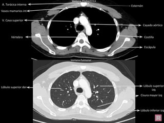Ventana Mediastínica
Ventana Pulmonar
Cayado aórtico
V. Cava superior
Costilla
Escápula
Esternón
Vértebra
A. Torácica interna
Vasos mamarios int
Lóbulo inferior izq
Lóbulo superior der Lóbulo superior
izq
Cisura mayor izq
 