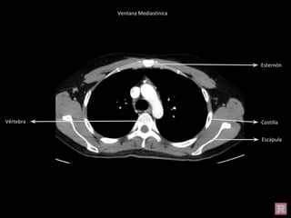 Costilla
Escápula
Esternón
Vértebra
Ventana Mediastínica
 