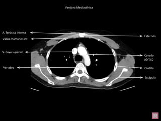 Cayado
aórtico
V. Cava superior
Costilla
Escápula
Esternón
Vértebra
A. Torácica interna
Vasos mamarios int
Ventana Mediastínica
 