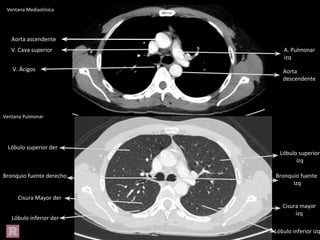 Ventana Mediastínica
Ventana Pulmonar
Bronquio fuente derecho Bronquio fuente
Izq
Cisura mayor
izq
Lóbulo inferior izq
Lóbulo superior
izq
Lóbulo superior der
Lóbulo inferior der
Cisura Mayor der
Aorta ascendente
Aorta
descendente
V. Cava superior A. Pulmonar
izq
V. Ácigos
 