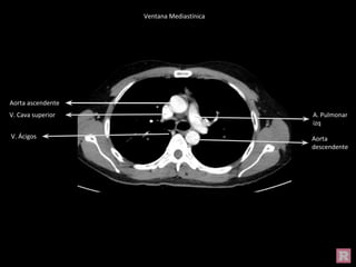 Aorta ascendente
Aorta
descendente
V. Cava superior A. Pulmonar
izq
V. Ácigos
Ventana Mediastínica
 