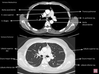 Ventana Mediastínica
Ventana Pulmonar
Cisura mayor izq
Cisura mayor der
Lóbulo inferior izq
Lóbulo superior izq
Lóbulo superior
der
Lóbulo inferior der
Aorta ascendente
Tronco pulmonar
V. cava superior
Aorta
descendente
A. pulmonar izq
V. Ácigos
 