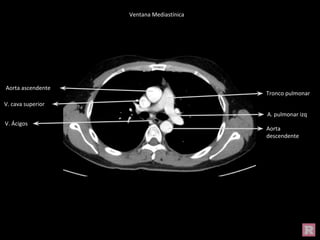 Aorta ascendente
Tronco pulmonar
V. cava superior
Aorta
descendente
A. pulmonar izq
V. Ácigos
Ventana Mediastínica
 