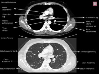 Ventana Mediastínica
Ventana Pulmonar
Cisura
mayor der
Lóbulo superior der
Lóbulo inferior der
Lóbulo superior izq
Lóbulo inferior izq
Cisura mayor izq
Aorta
descendente
V. Pulmonar izq
Arteria
pulmonar der
Rama de la
arteria
pulmonar izq
Aorta
ascendente
Vena cava
sup
Vena
Ácigos
 