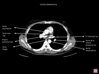 Aorta
descendente
V. Pulmonar izq
Arteria
pulmonar der
Rama de la
arteria
pulmonar izq
Aorta
ascendente
Vena cava
sup
Vena
Ácigos
Ventana Mediastínica
 