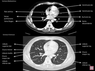 Ventana Mediastínica
Ventana Pulmonar
Aorta
descendente
Vena Ácigos
Aurícula izq
Ventrículo der
Raíz aórtica
Venas
pulmonares
Ventrículo Izq
Cisura
mayor izq
Lóbulo
inferior izq
Lóbulo
superior izq
Lóbulo
superior der
Lóbulo
inferior der
Cisura menor
Cisura
mayor der
Lóbulo medio
 