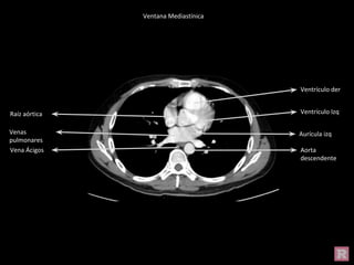 Aorta
descendente
Vena Ácigos
Aurícula izq
Ventrículo der
Raíz aórtica
Venas
pulmonares
Ventrículo Izq
Ventana Mediastínica
 
