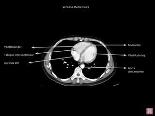 Miocardio
Ventrículo izq
Aorta
descendente
Ventrículo der
Aurícula der
Tabique interventricular
Ventana Mediastínica
 