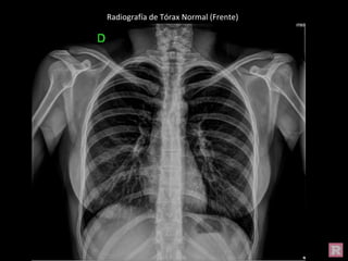 Radiografía de Tórax Normal (Frente)
 