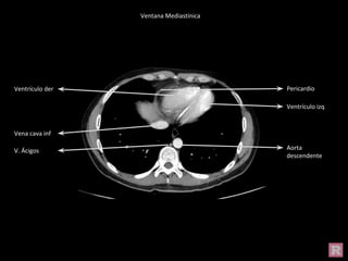 Ventrículo izq
Ventrículo der
V. Ácigos
Vena cava inf
Aorta
descendente
Pericardio
Ventana Mediastínica
 