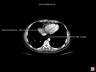 Cúpula diafragmática
Esófago
Ventana Mediastínica
 