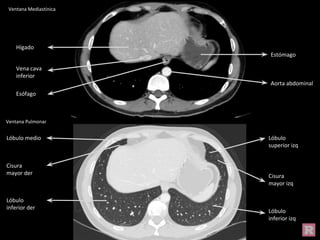 Ventana Mediastínica
Ventana Pulmonar
Hígado
Estómago
Vena cava
inferior
Aorta abdominal
Esófago
Lóbulo medio
Cisura
mayor der
Lóbulo
inferior der
Lóbulo
superior izq
Cisura
mayor izq
Lóbulo
inferior izq
 