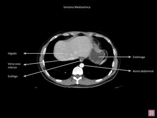 Hígado
Estómago
Vena cava
inferior
Aorta abdominal
Esófago
Ventana Mediastínica
 