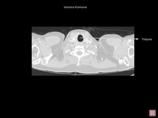 Tráquea
Ventana Pulmonar
 