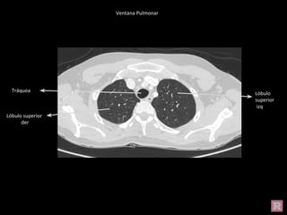 Tráquea
Lóbulo
superior
izq
Lóbulo superior
der
Ventana Pulmonar
 
