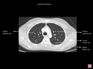 Ventana Pulmonar
Lóbulo
inferior izq
Lóbulo
superior der
Lóbulo
superior izq
Cisura
mayor izq
 