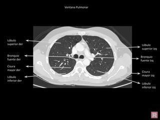 Ventana Pulmonar
Bronquio
fuente der
Bronquio
fuente Izq
Cisura
mayor izq
Lóbulo
inferior izq
Lóbulo
superior izq
Lóbulo
superior der
Lóbulo
inferior der
Cisura
mayor der
 