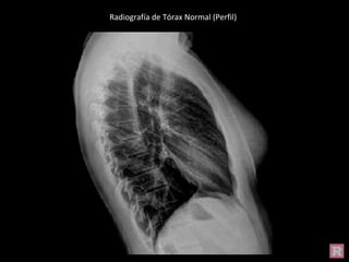 Radiografía de Tórax Normal (Perfil)
 
