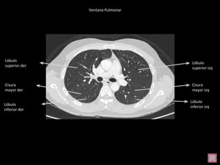 Ventana Pulmonar
Cisura
mayor izq
Cisura
mayor der
Lóbulo
inferior izq
Lóbulo
superior izq
Lóbulo
superior der
Lóbulo
inferior der
 