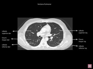 Ventana Pulmonar
Cisura
mayor der
Lóbulo
superior der
Lóbulo
inferior der
Lóbulo
superior izq
Lóbulo
inferior izq
Cisura
mayor izq
 