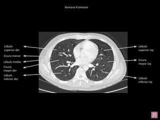 Ventana Pulmonar
Cisura
mayor izq
Lóbulo
inferior izq
Lóbulo
superior izq
Lóbulo
superior der
Lóbulo
inferior der
Cisura menor
Cisura
mayor der
Lóbulo medio
 