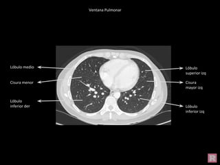 Ventana Pulmonar
Lóbulo
superior izq
Lóbulo
inferior izq
Cisura
mayor izq
Lóbulo medio
Lóbulo
inferior der
Cisura menor
 