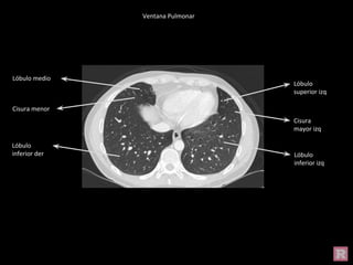 Ventana Pulmonar
Lóbulo medio
Lóbulo
inferior der
Lóbulo
superior izq
Lóbulo
inferior izq
Cisura menor
Cisura
mayor izq
 