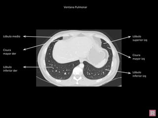 Lóbulo medio
Cisura
mayor der
Lóbulo
inferior der
Lóbulo
superior izq
Cisura
mayor izq
Lóbulo
inferior izq
Ventana Pulmonar
 