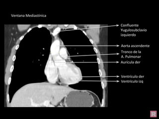 Aorta ascendente
Aurícula der
Tronco de la
A. Pulmonar
Ventrículo izq
Ventrículo der
Confluente
Yugulosubclavio
izquierdo
Ventana Mediastínica
 