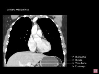 Diafragma
Estómago
Hígado
Vena Porta
Ventana Mediastínica
 