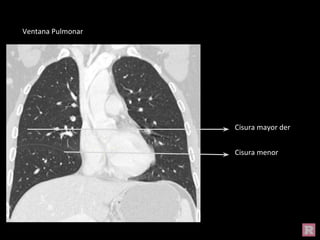Cisura mayor der
Cisura menor
Ventana Pulmonar
 