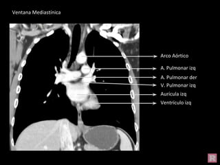 A. Pulmonar izq
Arco Aórtico
Ventrículo izq
Aurícula izq
A. Pulmonar der
V. Pulmonar izq
Ventana Mediastínica
 