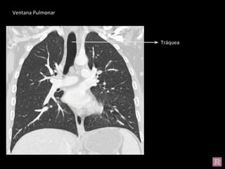 Tráquea
Ventana Pulmonar
 