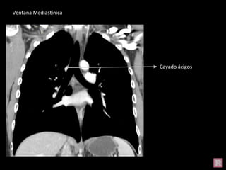 Cayado ácigos
Ventana Mediastínica
 