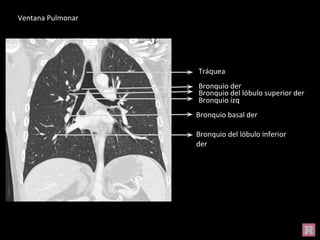 Bronquio del lóbulo inferior
der
Tráquea
Bronquio izq
Bronquio basal der
Bronquio der
Bronquio del lóbulo superior der
Ventana Pulmonar
 