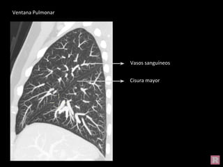 Vasos sanguíneos
Cisura mayor
Ventana Pulmonar
 