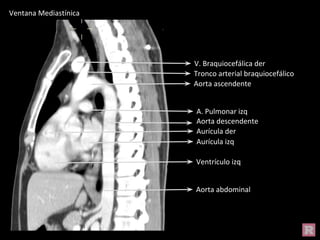Aorta abdominal
Aorta descendente
Aorta ascendente
V. Braquiocefálica der
Tronco arterial braquiocefálico
Ventrículo izq
Aurícula der
Aurícula izq
A. Pulmonar izq
Ventana Mediastínica
 