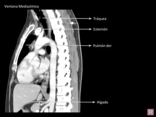 Hígado
Tráquea
Esternón
Pulmón der
Ventana Mediastínica
 
