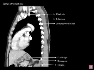 Estómago
Diafragma
Clavícula
Esternón
Hígado
Cuerpos vertebrales
Ventana Mediastínica
 